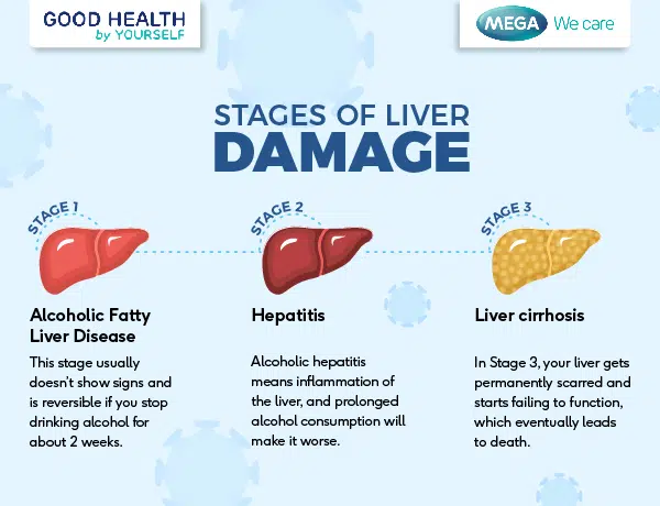 Image of the stages of liver disease, including fatty liver, hepatitis and cirrhosis.